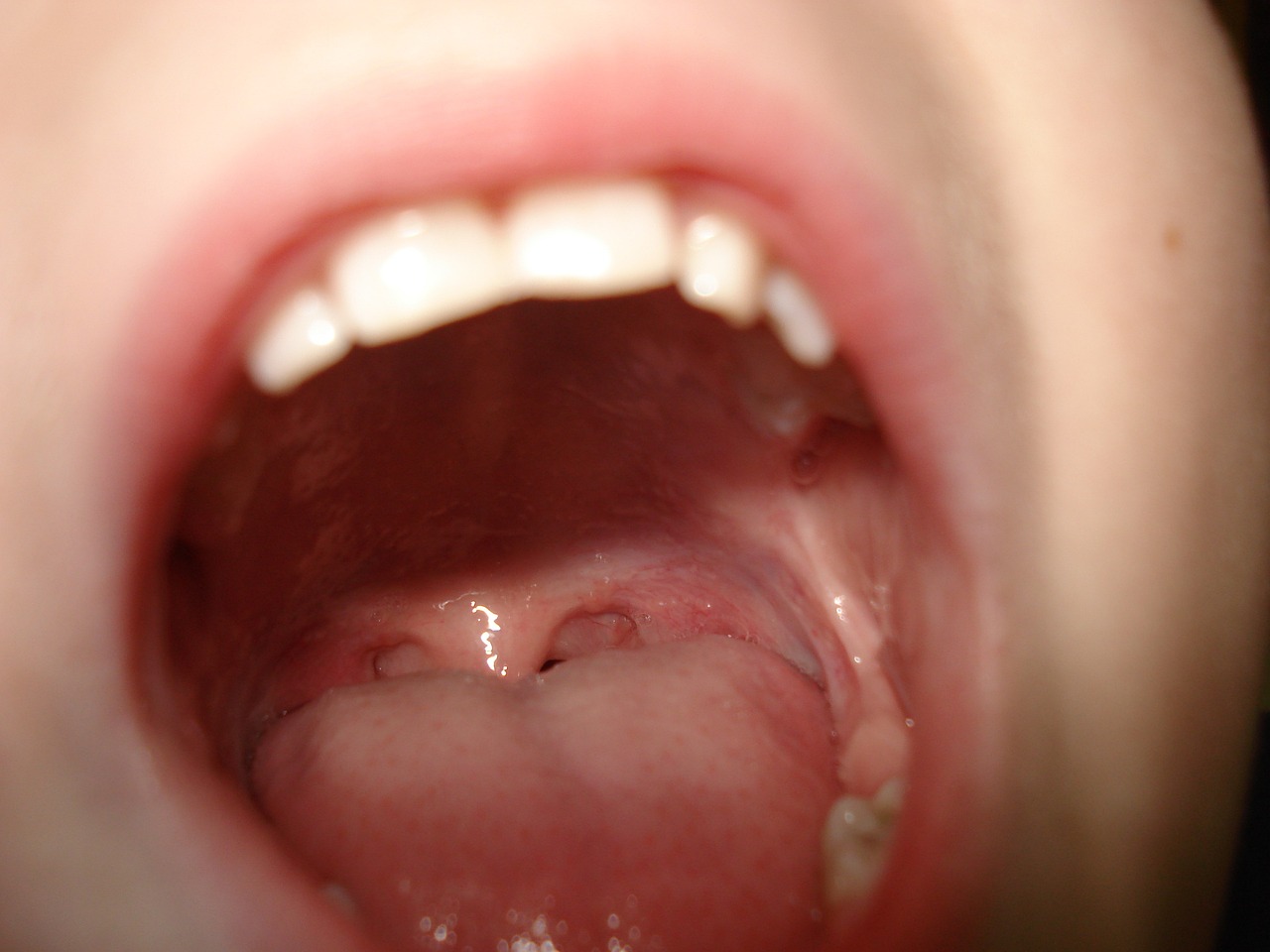 Woher kommt ein Pickel auf der Zunge
